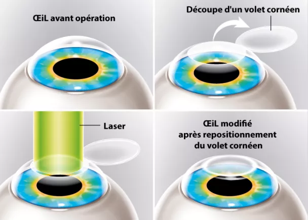 chirurgie refractive