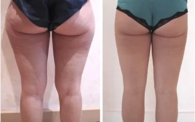 liposuccion culotte de cheval perdre culotté de cheval