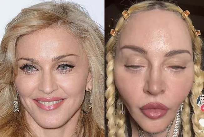 madonna chirurgie esthétique visage