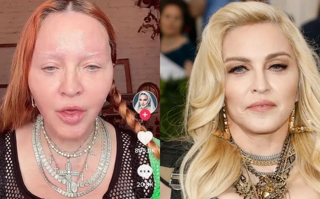 madonna chirurgie esthetique visage