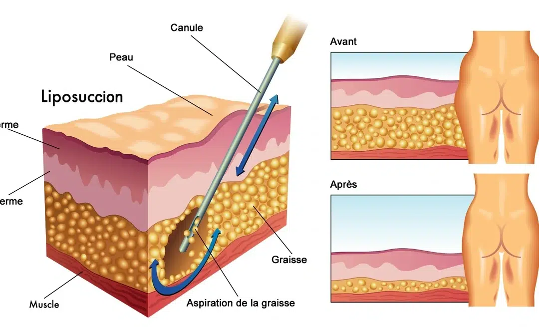 Où va la graisse après liposuccion ?