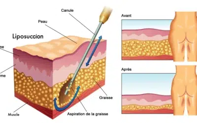ou va la graisse apres liposuccion Où va la graisse après liposuccion ?