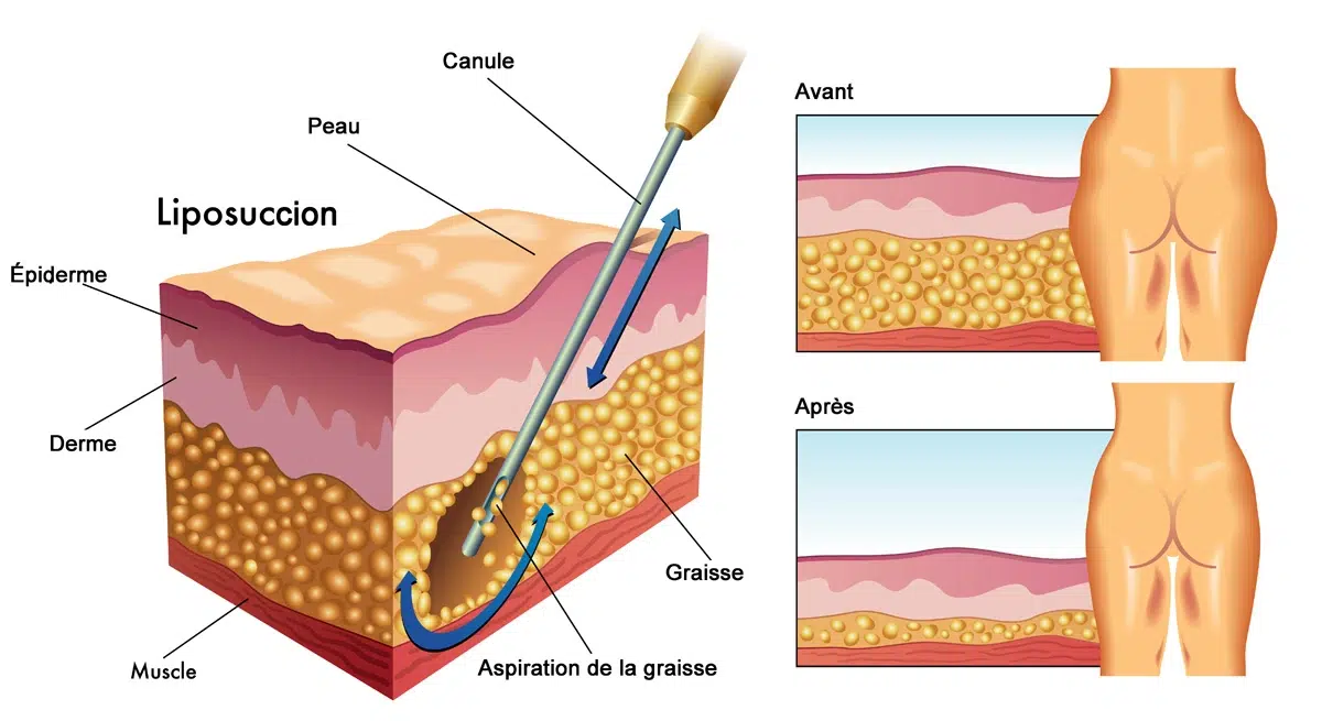 Où va la graisse après liposuccion ? , Quel est le prix d'une liposuccion du ventre ?