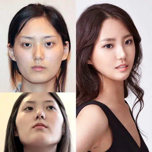 Star coréenne chirurgie esthétique avant après