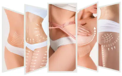 Combien de taille perd on apres une liposuccion Chirurgie esthétique franchir le cap