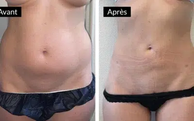 Liposuccion 10 ans apres Liposuccion 10 ans après