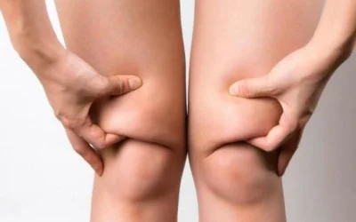 Liposuccion jambes avant apres 1 Liposuccion jambes avant apres