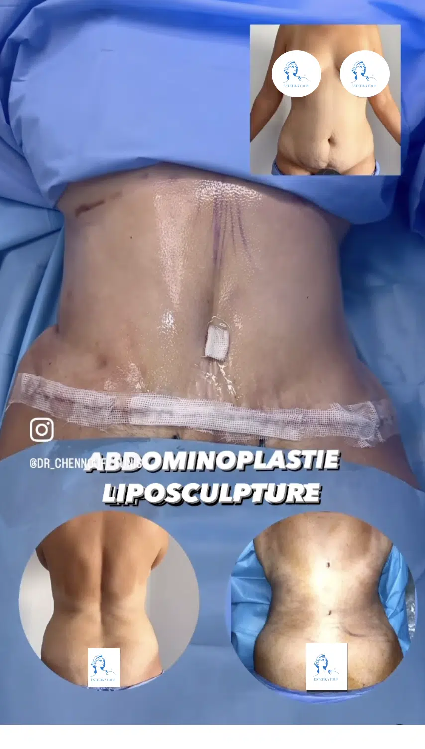 Prix chirurgie esthétique du ventre photos