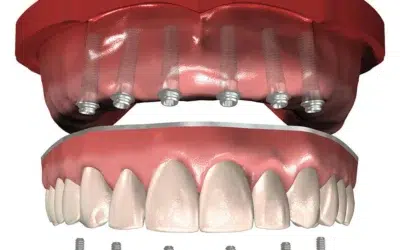 Prothese fixe sur 4 implants prix Prothèse fixe sur 4 implants prix