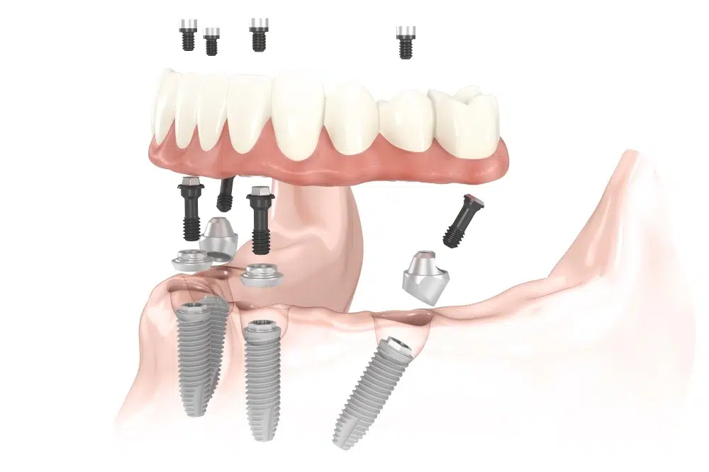 Prothèse fixe sur 4 implants prix all on 4