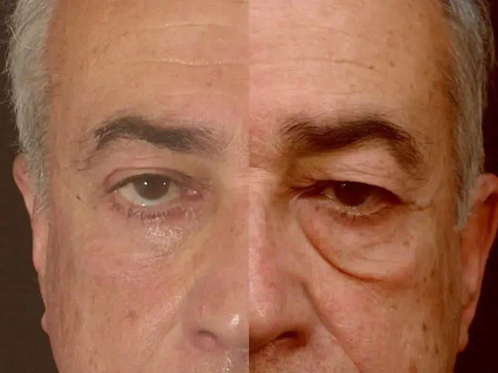 blepharoplastie