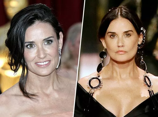 Demi moore chirurgie 