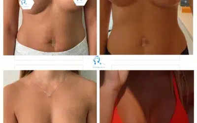 lipofilling mammaire tunisie Augmentation mammaire sécurité sociale