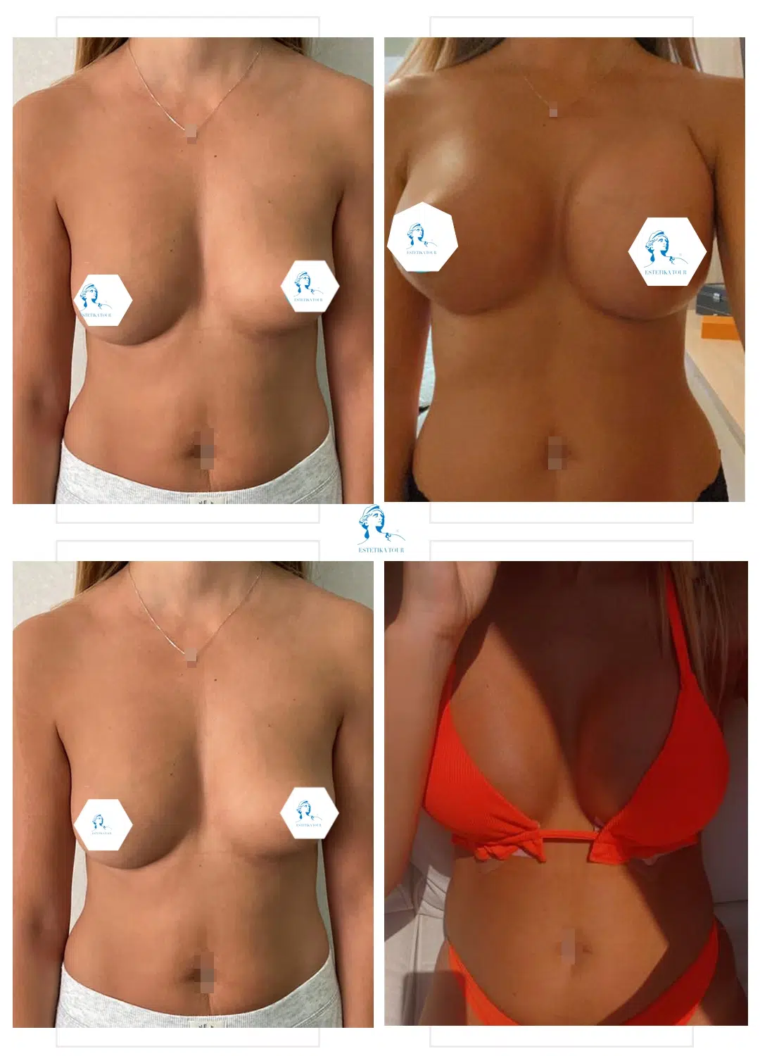 lipofilling mammaire tunisie prix, Augmentation mammaire sécurité sociale