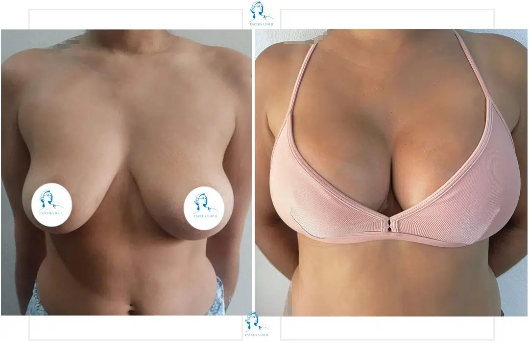 lipofilling mammaire tunisie prix, Augmentation mammaire sécurité sociale