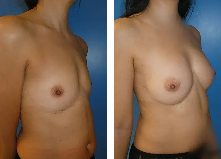 lipofilling seins tunisie