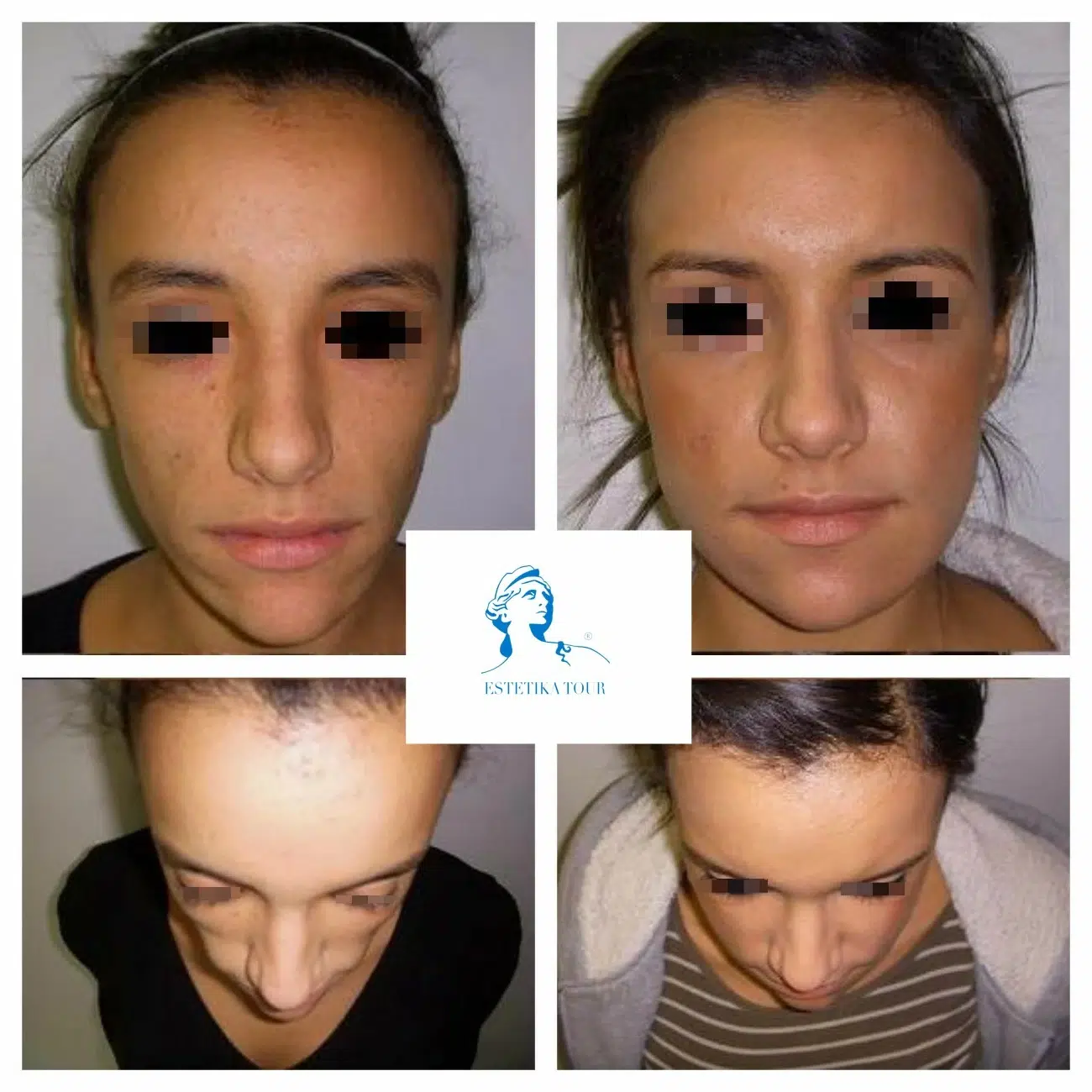 lipofilling visage