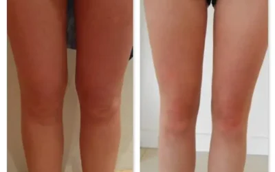 liposuccion cuisse genoux Chirurgie des cuisses prix