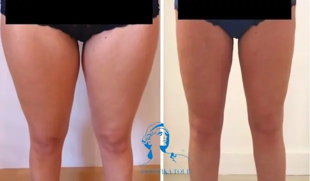 liposuccion cuisse genoux face interne