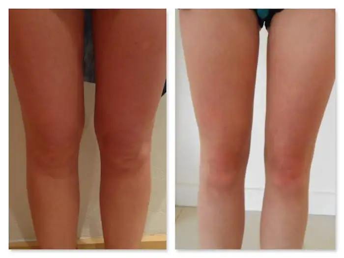 Chirurgie des cuisses prix