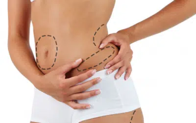 liposuccion ventre avant apres Liposuccion lyon