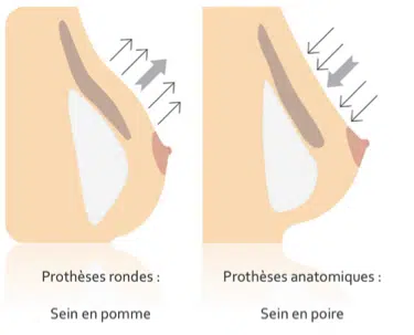 seins en poire potrine augmentation mammaire