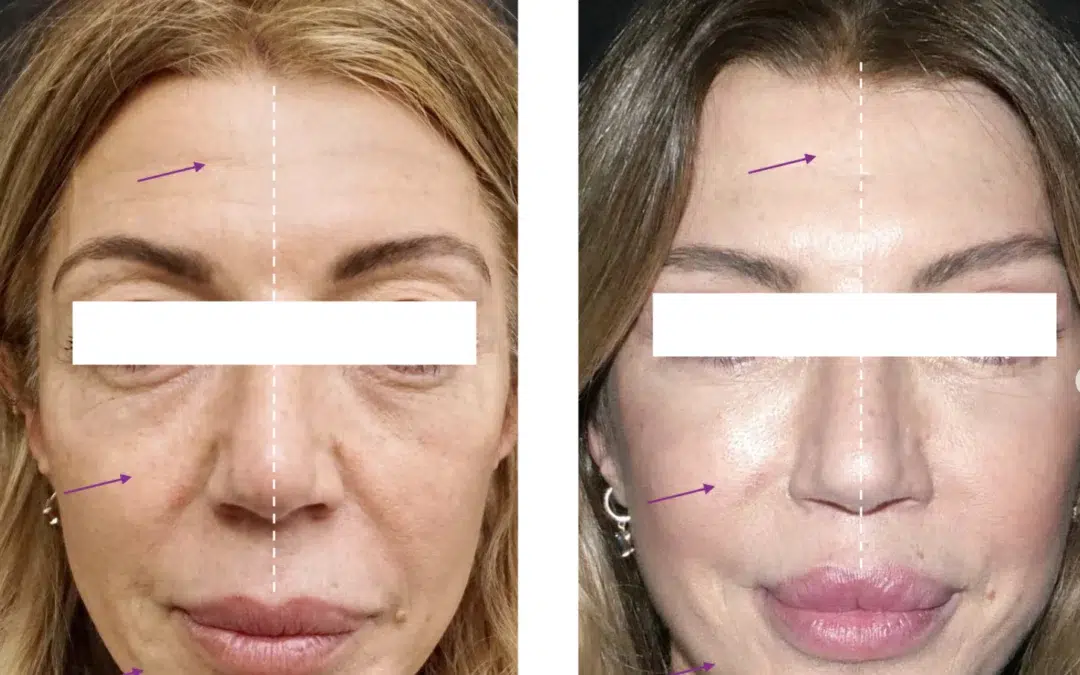 Comment se passe un lipofilling du visage