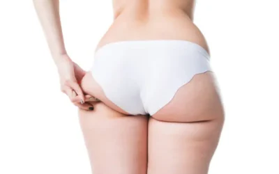 Liposuccion culotte de cheval prix Liposuccion culotté de cheval prix