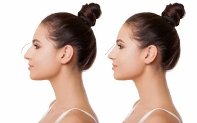 Quelle âge pour rhinoplastie ?