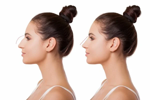 Quelle âge pour rhinoplastie ?