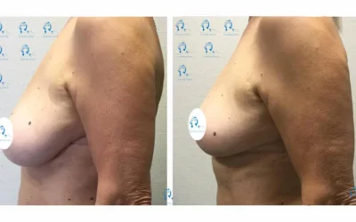 lifting seins et reduction mammaire Chirurgie mammaire ptose seins qui tombent