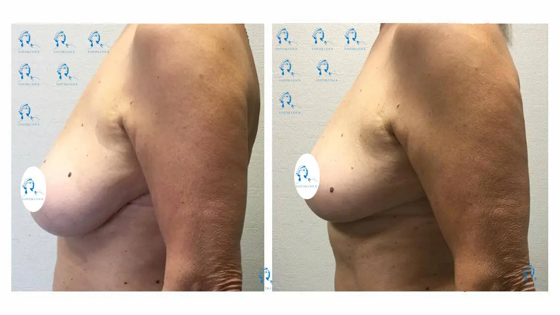 lifting seins et reduction mammaire