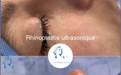 rhinoplastie ultrasonique 1 rhinoplastie ultrasonique