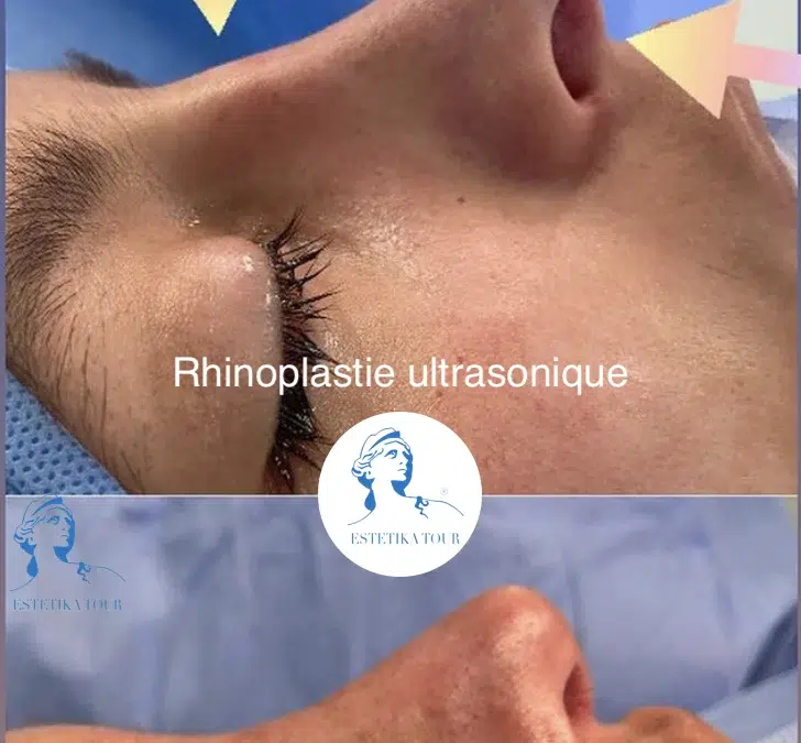 rhinoplastie ultrasonique