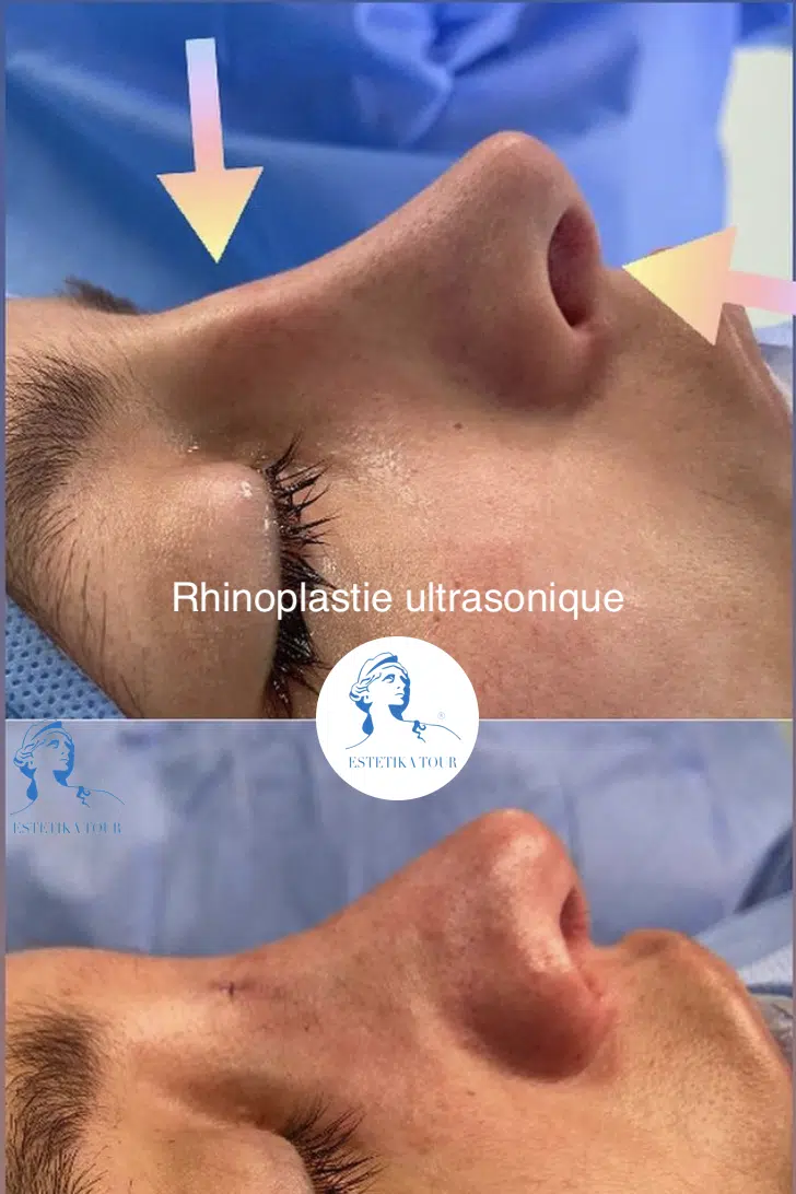 rhinoplastie ultrasonique