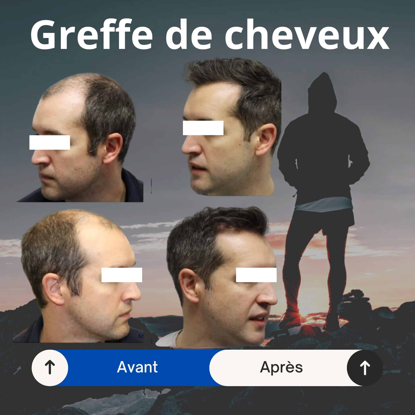 Greffe de cheveux prix