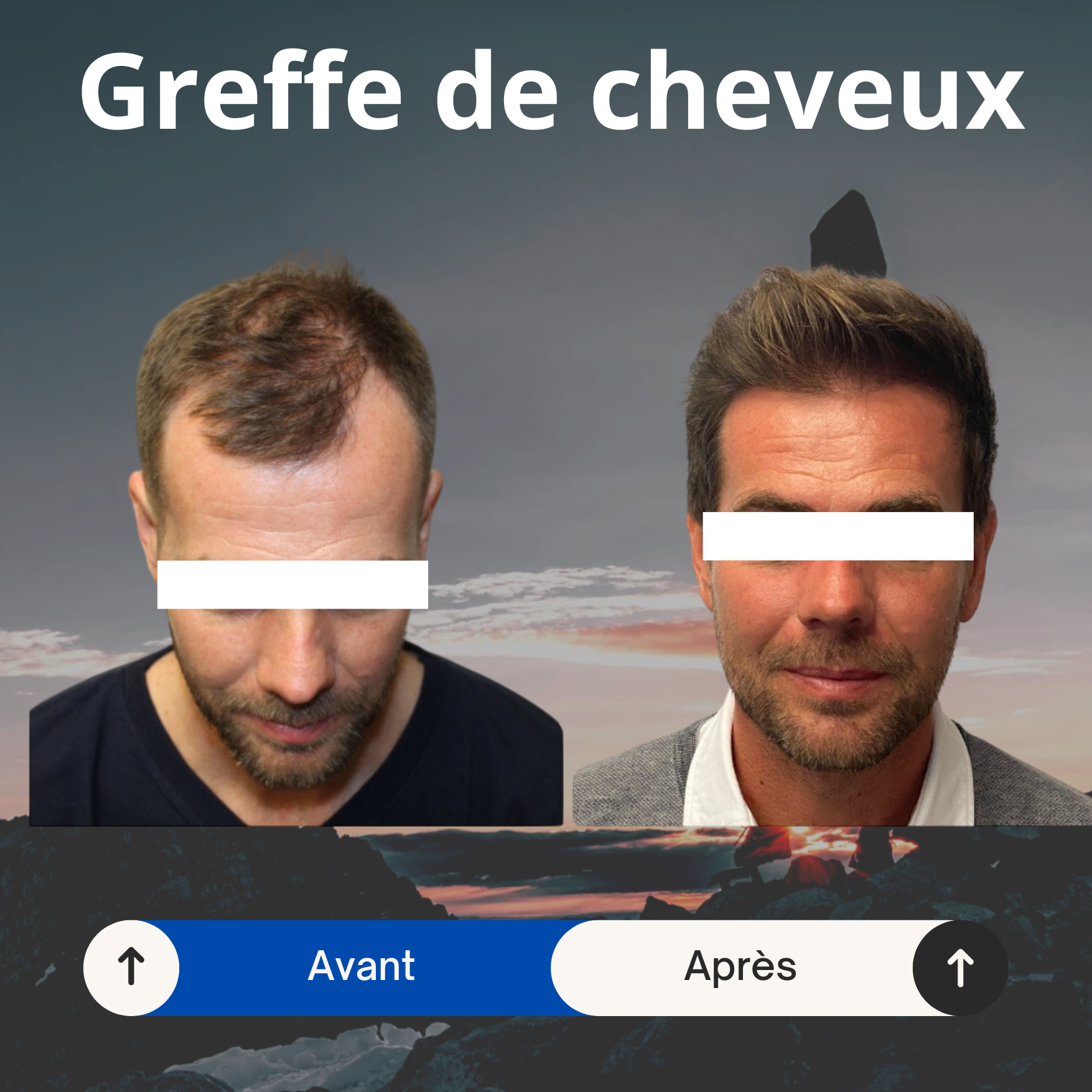 avant apres greffe cheveux-tunisie
