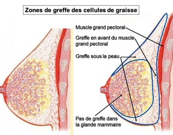 Lipofilling mammaire tunisie prix