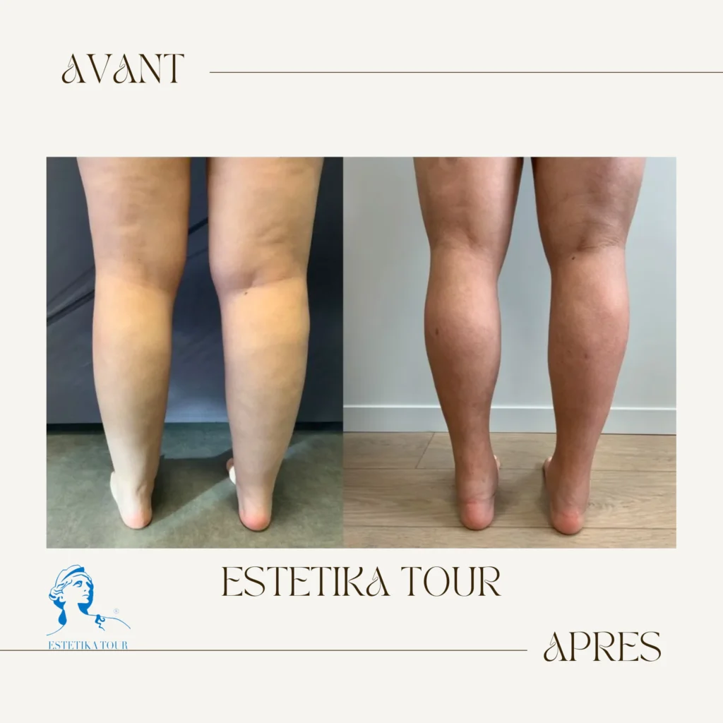 Liposuccion des mollets prix