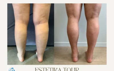 Liposuccion des mollets Liposuccion des mollets