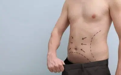 Quand voit on les resultats dune liposuccion Quand voit-on les résultats d’une liposuccion ?