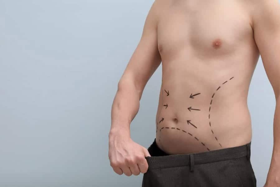 Quand voit-on les résultats d’une liposuccion ?