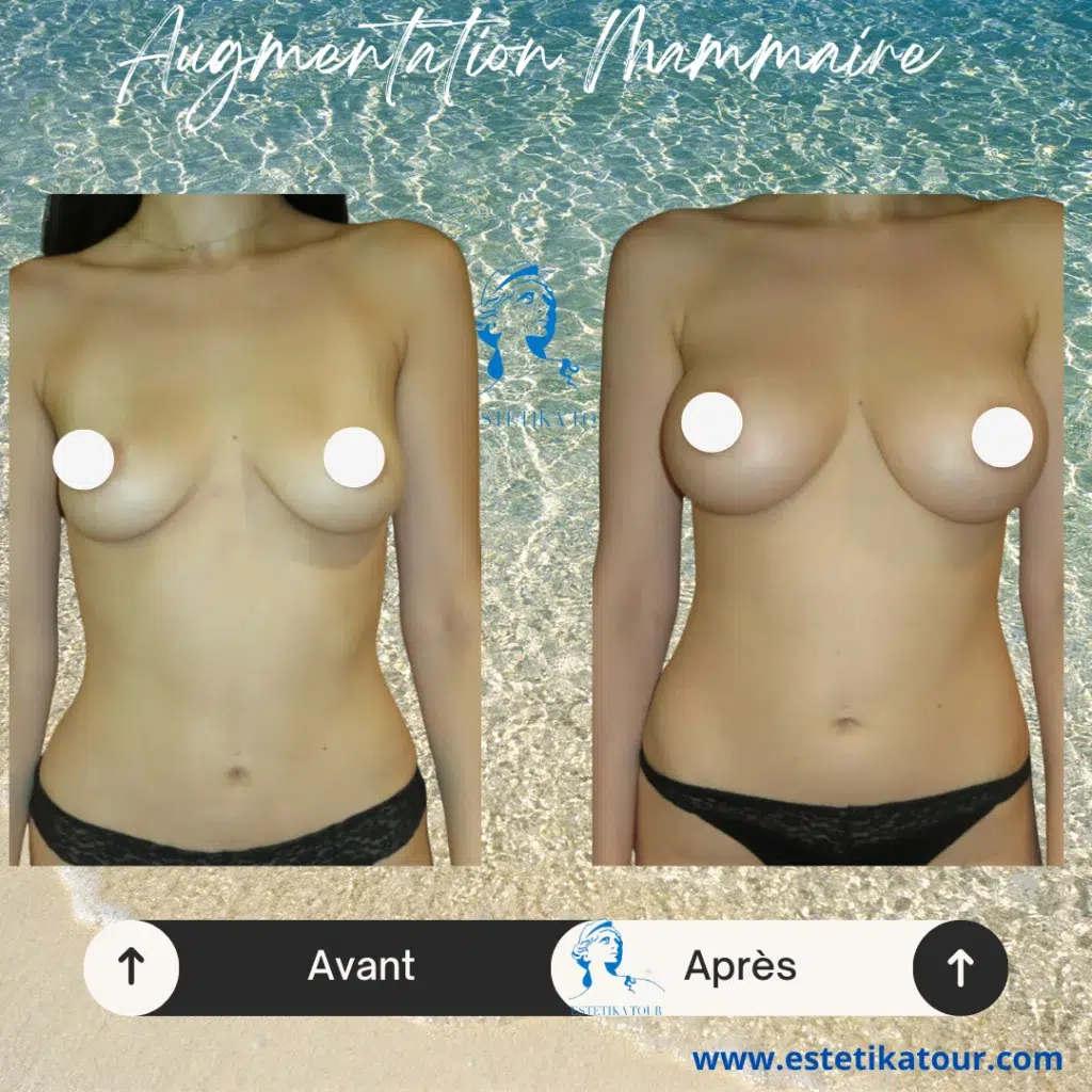 Tarif augmentation mammaire tunisie, Augmentation mammaire en tunisie, Comment faire grossir sa poitrine ?, Gros seins au naturel, Prix augmentation mammaire tunisie, Augmentation mammaire prix tunisie