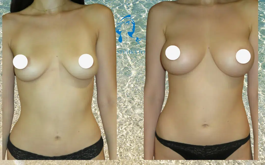 Tarif augmentation mammaire tunisie, Augmentation mammaire en tunisie, Comment faire grossir sa poitrine ?