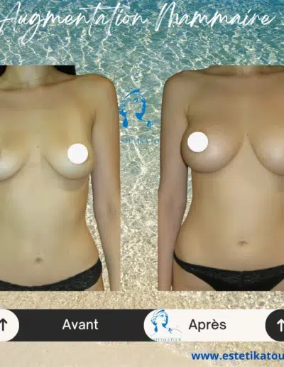 Tarif augmentation mammaire tunisie, Augmentation mammaire en tunisie, Comment faire grossir sa poitrine ?, Gros seins au naturel, Prix augmentation mammaire tunisie, Augmentation mammaire prix tunisie, Augmentation mammaire avis