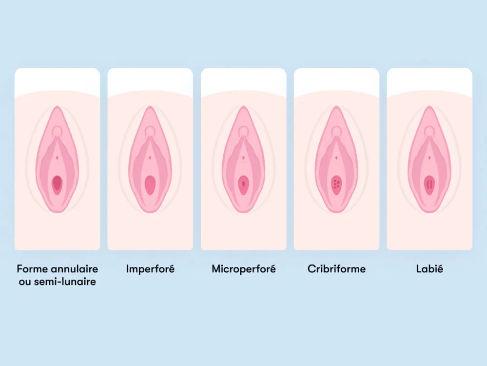 hymen perforé hymenoplastie