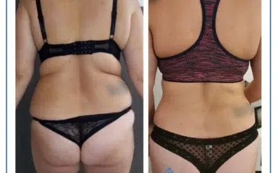liposuccion douce avant apres estetika Liposuccion paris pas cher