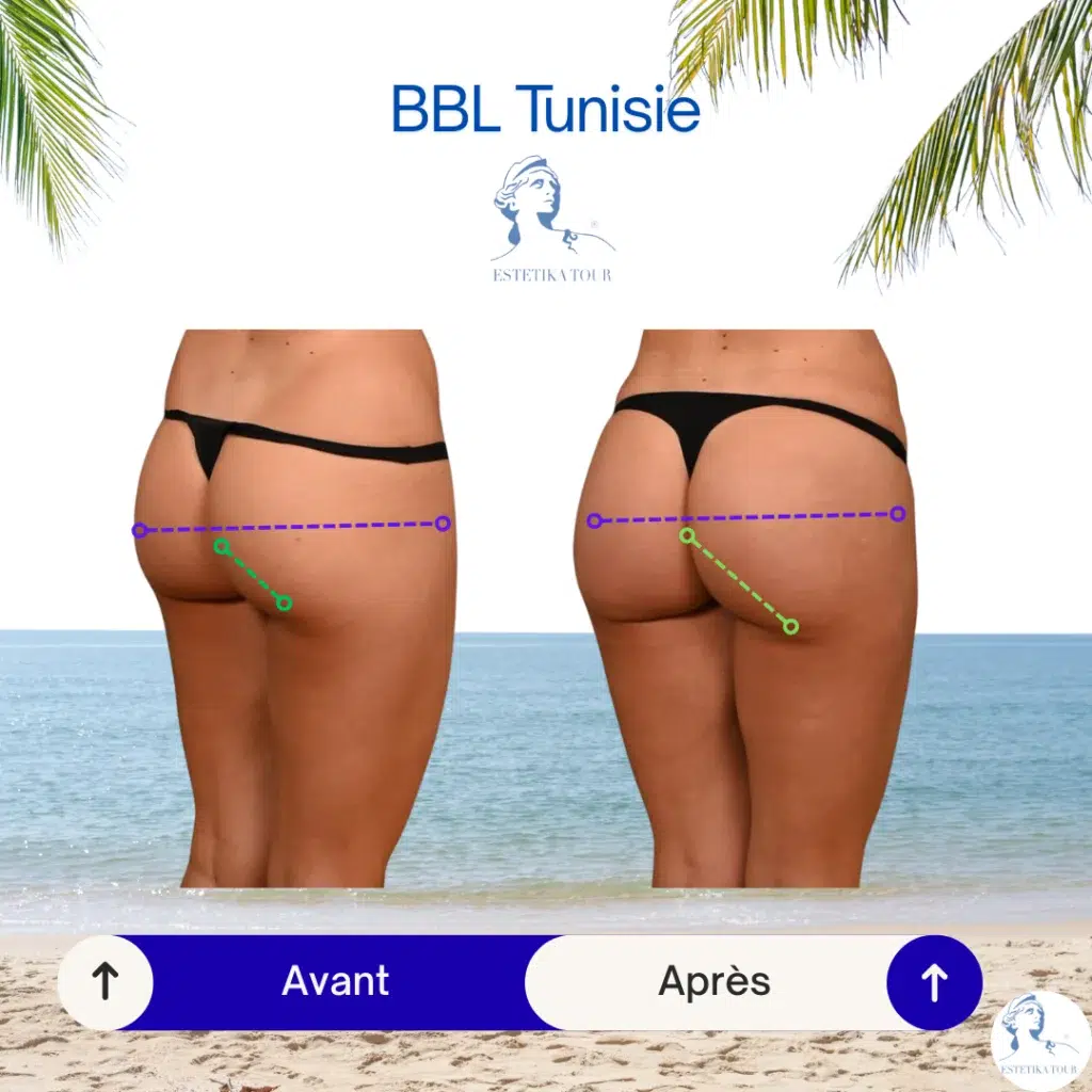 bbl tunisie, Découvrir le lifting brésilien, Comment embellir la zone des fesses