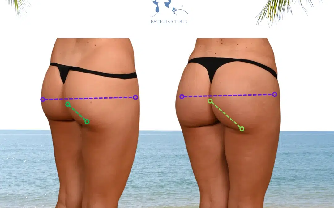 Lipofilling fesses tunisie