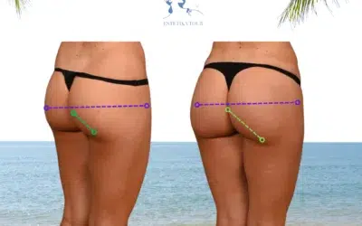 BBL Tunisie Lipofilling fesses